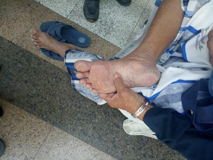 Kaki salah satu jemaah haji yang melepuh. (dok. Kementerian Kesehatan)