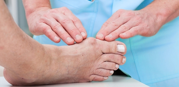 Ilustrasi penanganan benjolan (bunion) pada jempol kaki. (shutterstock)