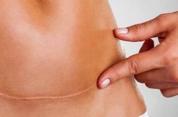Sembuhkan Luka Bekas Caesar, Ini Jenis Makanan yang Wajib Dimakan