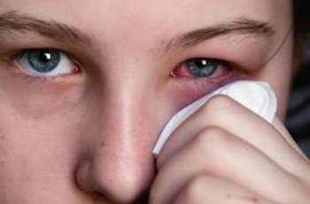 Lupa Lepas Lensa Kontak Saat Mandi, Mata Wanita Ini Hampir Buta