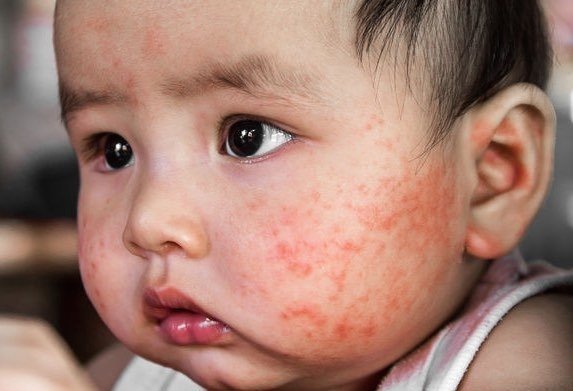Anak terinfeksi virus rubella. (HAWA Blog - HAWA Aplikasi Wanita)