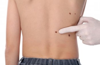 Alami Gatal di Perut Pasca Melahirkan, Wanita Ini Ternyata Idap Kanker