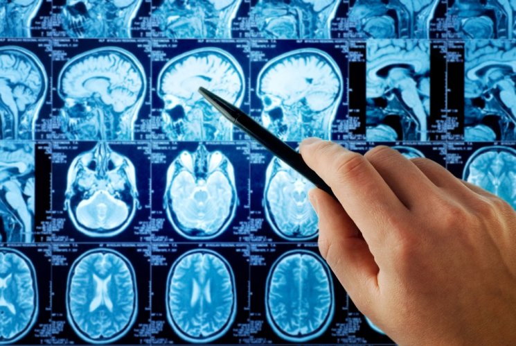 Ilustrasi tumor otak. (shutterstock)