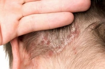 Kulit Kepala Sering Gatal? Waspada Kondisi Psoriasis