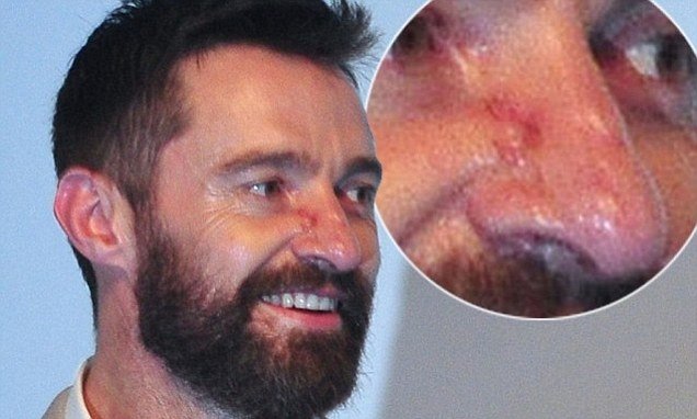 Jarang Pakai Sunscreen, Hugh Jackman Derita Kanker Kulit. (Daily Mail)