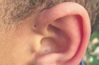 Mengenal Preauricular Sinus, Lubang Kecil di Atas Daun Telinga