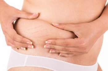 Yuk, Samarkan Stretch Mark dengan Tips Mudah Ini