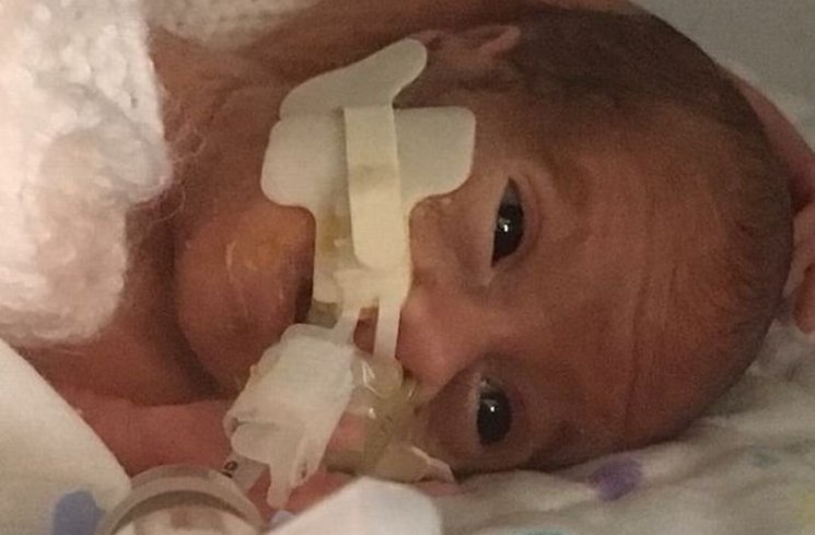 Bayi George Beadle sedang berjuang untuk hidupnya. (Hull Daily Mail WS)