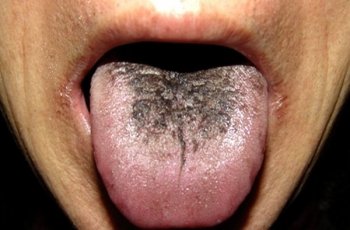 Langka, Lidah Wanita Ini Menghitam dan Berbulu Usai Konsumsi Obat