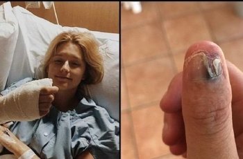 Hobi Gigit Kuku, Jempol Tangan Gadis Ini Diamputasi