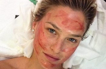 Ngeri! Vampire Facial, Praktik Kecantikan Wajah dengan Darah