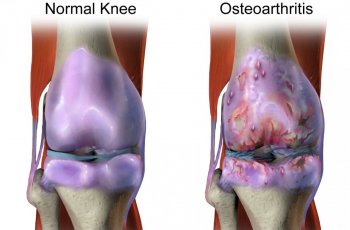 Studi Terbaru, Antioksidan Bisa Cegah Osteoartritis