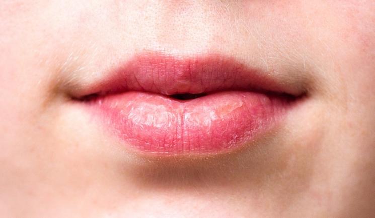 Bibir kering. (pixabay)