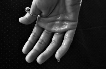 Dua Langkah Mudah Mengatasi Hyperhidrosis