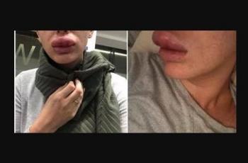 Waduh, Bibir Wanita Ini Hampir Hilang Gegara Suntik Filler