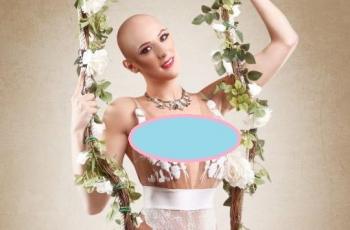 Derita Alopecia, Wanita-Wanita Ini Tampil Cantik Ala Model