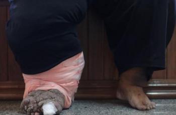 Kena Infeksi Kaki Gajah, Tawheeda Terpaksa Relakan Keinginannya Ini