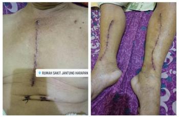 Ngeri! Kaki dan Dada Seorang Ayah Dibedah Akibat Sering Merokok