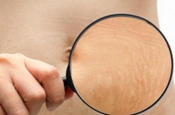 Wanita Ini Pakai ASI untuk Hilangkan Stretch Marks, Begini Hasilnya