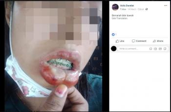 Pakai Behel Palsu, Wanita Ini Demam Tinggi dan Bibirnya Bengkak