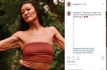 Idap Kelainan Langka, Kulit Model Ini Kendur Walau Masih 20-an Tahun