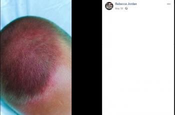 Viral Ibu Ini Curhat Kepala Anaknya Memar Parah Akibat Berputar di Ayunan