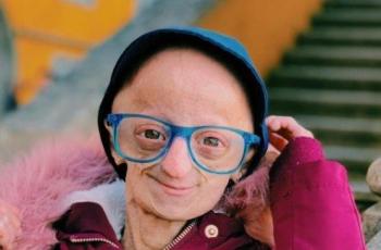 Wanita Ini Terlihat seperti Nenek-Nenek Meski Usianya 20 Tahun, karena Apa?