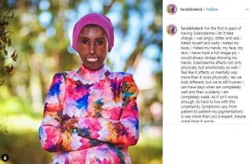 Mengenal Scleroderma, Penyakit yang Buat Farah Khaleck Takut Bercermin!