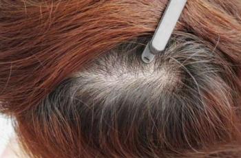 Peneliti Temukan Cara Cegah Kerontokan Rambut Akibat Kemoterapi