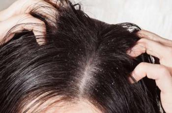 Bukan Penyebab Utama, Tapi Ketombe Bisa Bikin Rambut Rontok