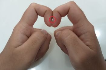 Tes Deteksi Kanker Paru-Paru, Coba Gabungkan Dua Jari Telunjuk